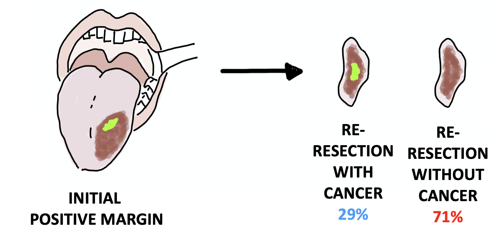 Graphic of oral cavity with cancer with arrow pointing to re-resection specimens with and without cancer